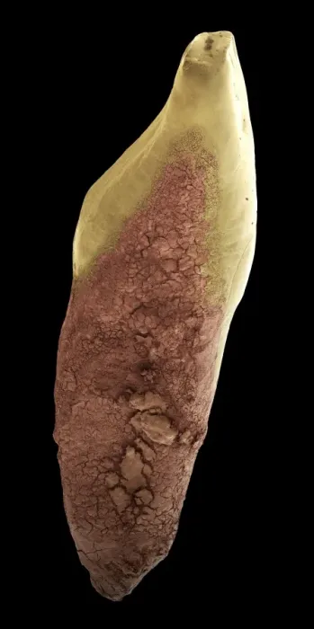 Impresión enmarcada : Decay of teeth (SEM) Impresión enmarcada : Decay of teeth (SEM)