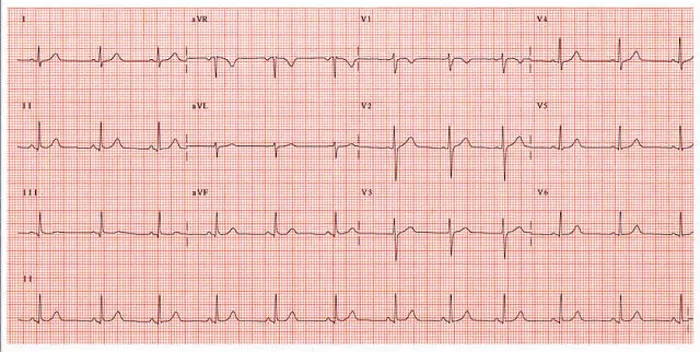 Impresión enmarcada : Electrocardiograma normal. Impresión enmarcada : Electrocardiograma normal.