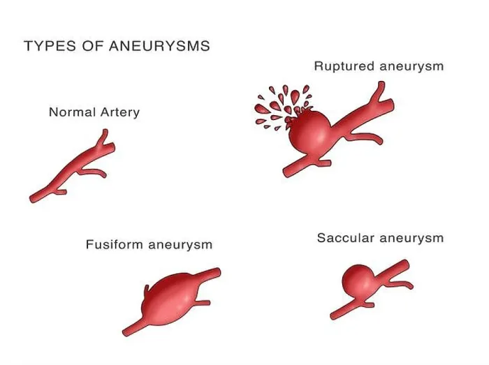 Impresión enmarcada : Tipos de Aneurismas. Impresión enmarcada : Tipos de Aneurismas.