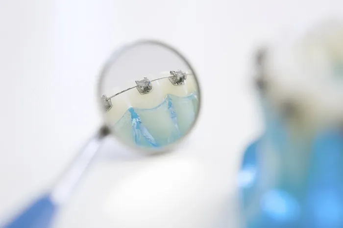 Impresión enmarcada : Detalle de un modelo de dientes con brackets. Impresión enmarcada : Detalle de un modelo de dientes con brackets.