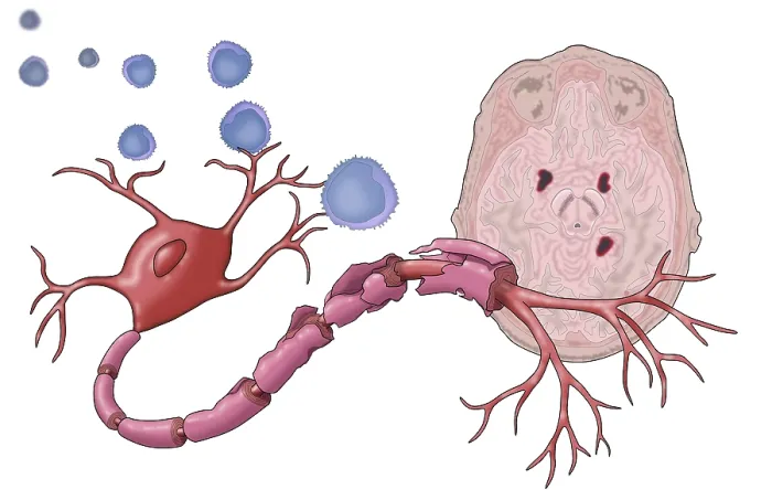 Impresión enmarcada : Esclerosis Múltiple
