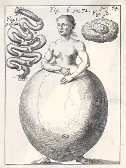 19th Century Medical Art Imprime: Hideous Deformity