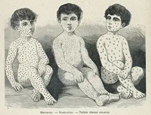 Historical Medical Images Imprime: Measles Compared