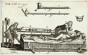 Medical Illustration Art Imprime: Setting a Bone 1682