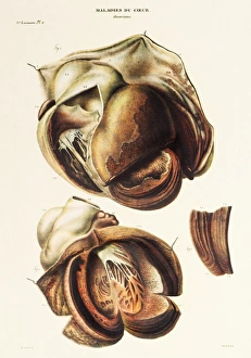 Impresiones de Aneurisma aórtico. Arte de Jean Cruveilhiers libro médico Anatomie pathalogique du corps humain, publicado en 1835 Imágenes fechadas en enero de 2007: Anuria aórtica
