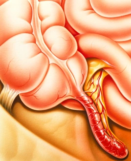 Imágenes fechadas en abril de 2012: Arte de un apéndice con inflamación del apéndice