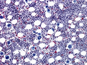 Impresiones de Hígado óseo micrografia ligera. Las grandes células azules son megacariocitos que forman plaquetas. Las células moradas oscuro purpura son isletas eritoplásticas, que forman glóbulos rojos Imágenes fechadas en marzo de 2010: Hígado óseo, micrografía de luz fina