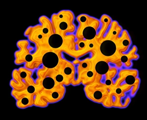 Impresiones de Daño cerebral. Ilustración conceptual del daño cerebral representada como agujeros en un escaneo de tomografía computarizada (CT) coloreado de la corteza cerebral humana Imágenes de 2000: Daño cerebral