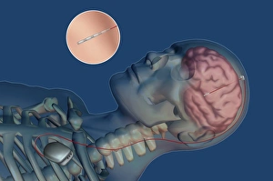 Deep Brain Stimulation Imprime: Brain pacemaker, artwork