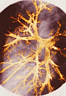 Impresiones de Bronquitis. Gráfica de colores del bronceografía (rayos X) de los bronquiolos hinchados (naranja) en el pulmón derecho Imágenes de junio de 2005: Neumonía de los bronquios, radiografía