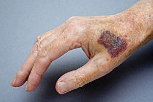 Imágenes fechadas en abril de 2008: Mano empujada o magullada