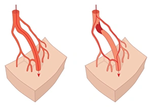 Circulatory System Artwork Imprime: Collateral circulation, artwork