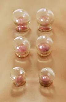 Impresiones de El modelo se ha liberado. El tinte de la caza es una práctica derivada del medicina china y se utiliza en el tratamiento de condiciones respiratorias y dolores musculoesqueléticos Imágenes fechadas en abril de 2006: Cupping