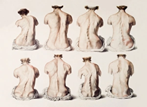 19th Century Medical Illustrations Imprime: Back deformities