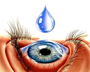 Impresiones de Conjuntivitis. El arte de un gotero en el ojo que sufre de conjunctivitis Imágenes de marzo de 2002: Ojo con conjuntivitis