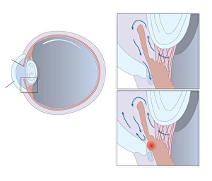 Glaucoma Treatment Imprime: Glaucoma, artwork