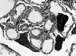 Impresiones de El glomerulus. Micrografía de transmisión electrónica (TEM) de una sección a través un nefrón en el riñón humano Imágenes fechadas en febrero de 2013: Golónculo, Técnico de Emergencia Médica