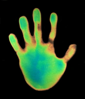 Thermography Images Imprime: Hand, thermogram