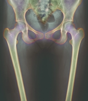 Impresiones de Las articulaciones de la cadera. Rayos X coloreados del muslo y las piernas superiores de una mujer, revelando los huesos que forman sus articulaciones de la cadera Imágenes fechadas en 2002: Huesos de cadera, rayo-X