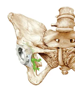 Impresiones de Reemplazo de cadera: Artwork del hueso femoral (hombrecito) con cabeza que se ajustará a este espacio en el pelvis para formar la articulación de la cadera Imágenes fechadas en junio de 2011: Sustitución de cadera con arte