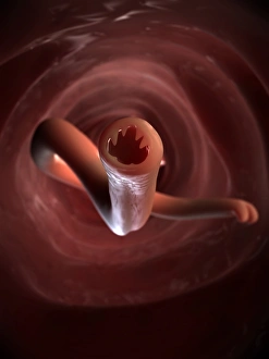 Intestinal Parasites Imprime: Hookworm, artwork