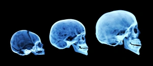 Impresiones de El desarrollo del hueso humano. Radiografía coloreada de tres cráneos humanos incluyendo un recién nacido, un niño y una persona adulta Imágenes fechadas en abril de 2006: Desarrollo de la cránea humana