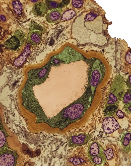 Coloured TEM Images Imprime: Hydronephrosis