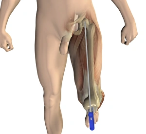 Osteoarthritis Treatment Options Imprime: Knee replacement alignment, artwork
