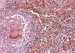 Mycobacterium Tuberculosis Bacteria Imprime: Miliary tuberculosis, light micrograph