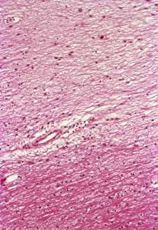 Imágenes fechadas el 4 de marzo de 2013: Esclerosis múltiple, imagen bajo microscopio