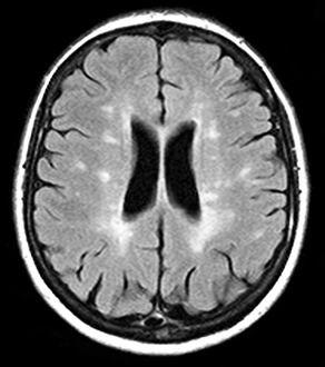 Magnetic Resonance Imaging Scans Imprime: Multiple sclerosis, MRI scan