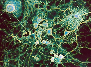 Imágenes fechadas en abril de 2012: Esclerosis múltiple, SEM
