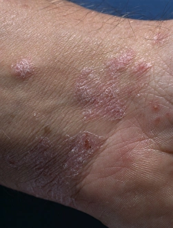 Imágenes de junio de 2003: Psoriasis