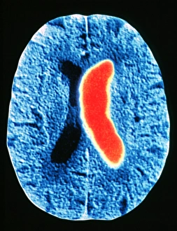 Computed Tomography Scans Imprime: Stroke