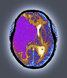 Imágenes fechadas el 4 de marzo de 2013: Ataque cerebral, escaneo de tomografía computarizada