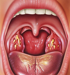 Impresiones de Tonsilitis. El arte de la boca y garganta abierta del paciente con las amígdalas inflamadas Imágenes fechadas en septiembre de 2004: Tonsillitis