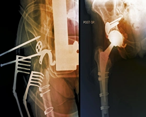 Hip Replacement Surgery Imprime: Total hip replacement, X-rays