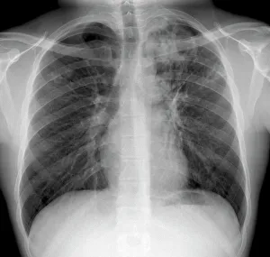 Mycobacterium Tuberculosis Bacteria Imprime: Tuberculosis, X-ray