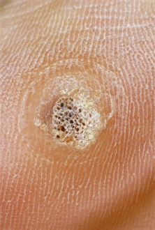 Impresiones de Una verruga (o plantar warts), una pequeña crecimiento benigno en la piel causado por una infección viral Imágenes de noviembre de 2004: Verruca