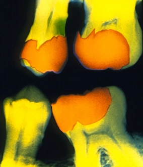 Dental X Ray Imprime: X-ray of teeth