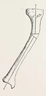 Antique Surgical Instruments Imprime: A B C