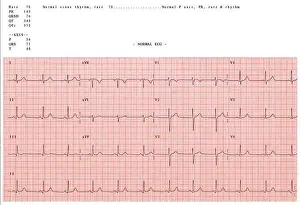 Electrocardiograma normal.