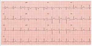 Impresión enmarcada : Electrocardiograma normal. Impresión enmarcada : Electrocardiograma normal.