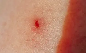 Freshwater Fish Habitat Imprime: Tick bite
