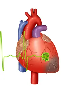 Medical Anatomy Drawing Imprime: Heart Attack