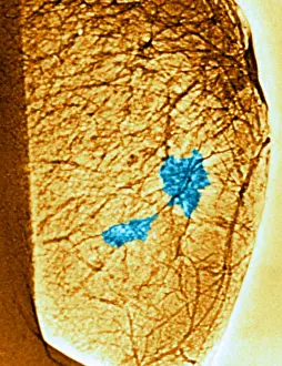 Medical Imaging Techniques Imprime: Mammogram