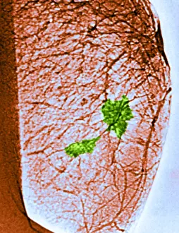 Medical Imaging Techniques Imprime: Mammogram