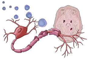 Esclerosis Múltiple