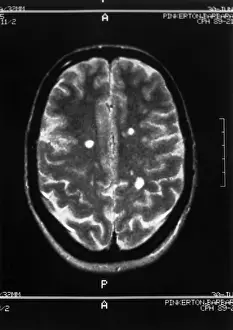 Medical Imaging Techniques Imprime: Multiple sclerosis