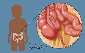 Human Digestive System Illustration Imprime: Normal Appendix
